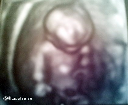 beba u 13. nedelji trudnoce 4D