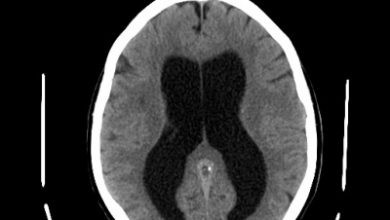 ultrazvuk mozga novorođenčeta