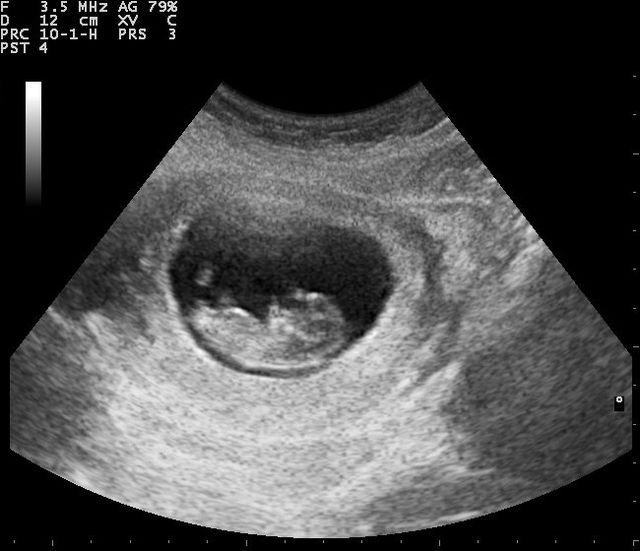 Pregnancy ultrasound 110322105347 1056300